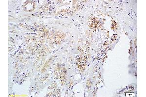 Formalin-fixed and paraffin embedded human cervical carcinoma labeled with Anti FUT8 Polyclonal Antibody, Unconjugated (ABIN716801) at 1:200 followed by conjugation to the secondary antibody and DAB staining
