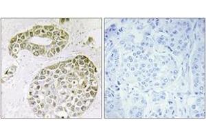 Immunohistochemistry analysis of paraffin-embedded human breast carcinoma tissue, using hnRNP M Antibody. (HNRNPM antibody  (AA 11-60))
