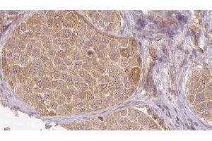 ABIN6272659 at 1/100 staining Human Melanoma tissue by IHC-P. (MFGE8 antibody  (C-Term))