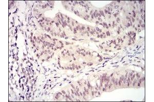 Immunohistochemical analysis of paraffin-embedded human rectum cancer tissues using CDK4 mouse mAb with DAB staining.