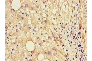Immunohistochemistry of paraffin-embedded human liver cancer using ABIN7156880 at dilution of 1:100 (EBI3 antibody  (AA 21-227))