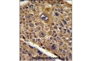 Formalin-fixed and paraffin-embedded human hepatocarcinoma reacted with TOB1 Antibody (N-term), which was peroxidase-conjugated to the secondary antibody, followed by DAB staining. (Protein Tob1 (TOB1) (AA 54-83), (N-Term) antibody)