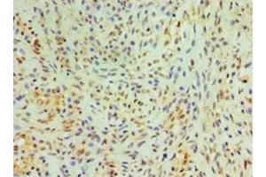 Immunohistochemistry of paraffin-embedded human breast cancer using ABIN7149005 at dilution of 1:100 (CST4 antibody  (AA 21-141))
