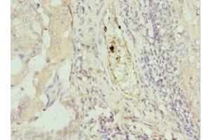 Immunohistochemistry of paraffin-embedded human lung cancer using ABIN7172749 at dilution of 1:100 (Protein C8orf4 (TCIM) (AA 1-106) antibody)