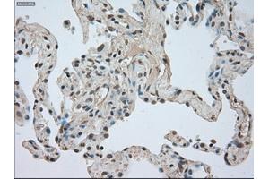 Immunohistochemical staining of paraffin-embedded Adenocarcinoma of breast tissue using anti-NTRK3 mouse monoclonal antibody. (NTRK3 antibody)