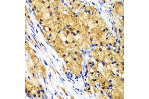 Immunohistochemistry of paraffin-embedded human lung cancer using CAPG Antibody. (CAPG antibody  (AA 1-348))
