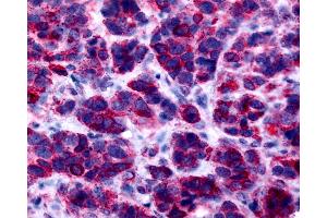 Anti-GPER1 / GPR30 antibody IHC of human breast, carcinoma. (GPER antibody  (Cytoplasmic Domain))