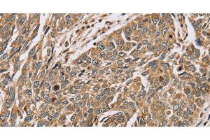 Immunohistochemistry of paraffin-embedded Human lung cancer using PTGER2 Polyclonal Antibody at dilution of 1:45 (PTGER2 antibody)