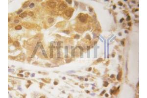 ABIN6269055 at 1/50 dilution staining IKB epsilon in human breast carcinoma by Immunohistochemistry using paraffin-embedded tissue