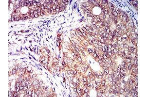 Immunohistochemical analysis of paraffin-embedded cervical cancer tissues using CD158E1 mouse mAb with DAB staining.