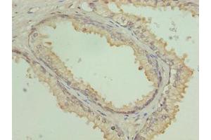 Immunohistochemistry of paraffin-embedded human prostate cancer using ABIN7148453 at dilution of 1:100 (COG3 antibody  (AA 101-400))