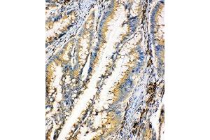 Anti-HEXA antibody, IHC(P) IHC(P):Human Intestinal Cancer Tissue (Hexosaminidase A antibody  (Middle Region))