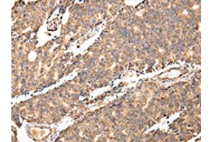The image on the left is immunohistochemistry of paraffin-embedded Human prostate cancer tissue using ABIN7128064(UGGT2 Antibody) at dilution 1/20, on the right is treated with fusion protein. (UGCGL2 antibody)