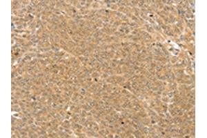 The image on the left is immunohistochemistry of paraffin-embedded Human ovarian cancer tissue using ABIN7192889(TRIM22 Antibody) at dilution 1/25, on the right is treated with synthetic peptide. (TRIM22 antibody)