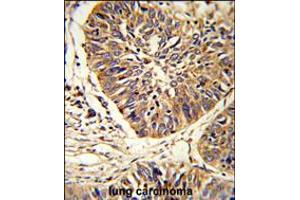 Formalin-fixed and paraffin-embedded human lung carcinoma reacted with PDIA3 Antibody , which was peroxidase-conjugated to the secondary antibody, followed by DAB staining. (PDIA3 antibody  (C-Term))