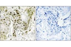 Immunohistochemistry analysis of paraffin-embedded human breast carcinoma tissue, using BCOR Antibody. (BCOR antibody  (AA 1231-1280))
