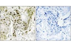 Immunohistochemistry analysis of paraffin-embedded human breast carcinoma tissue, using BCOR Antibody. (BCOR antibody  (AA 1231-1280))