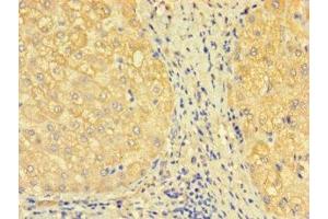 Immunohistochemistry of paraffin-embedded human liver tissue using ABIN7171277 at dilution of 1:100 (SDCBP2 antibody  (AA 11-207))