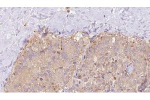 ABIN6273327 at 1/100 staining Human thyroid cancer tissue by IHC-P. (Syntaxin 17 antibody  (C-Term))