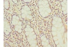 Immunohistochemistry of paraffin-embedded human colon cancer using ABIN7145307 at dilution of 1:100 (BCL2-Like 15 antibody  (AA 1-163))