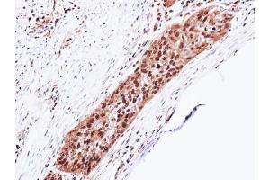 IHC-P Image Immunohistochemical analysis of paraffin-embedded H1299 xenograft, using Proteasome 20S alpha 5, antibody at 1:100 dilution. (PSMA5 antibody  (Center))