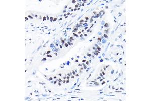 Immunohistochemistry of paraffin-embedded human colon carcinoma using SUPT5H/SPT5 Rabbit mAb (ABIN7270878) at dilution of 1:100 (40x lens). (SUPT5H antibody)
