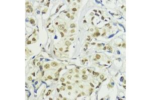 Immunohistochemistry of paraffin-embedded human mammary cancer using BA antibody (ABIN7265937) at dilution of 1:200 (40x lens). (BAZ2A antibody)