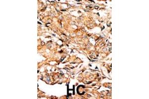 Formalin-fixed and paraffin-embedded human cancer tissue reacted with the primary antibody, which was peroxidase-conjugated to the secondary antibody, followed by AEC staining. (RAD9A antibody  (pSer277))