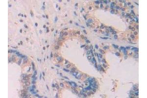 Detection of Ab1-42 in Human Prostate Tissue using Monoclonal Antibody to Amyloid Beta Peptide 1-42 (Ab1-42) (Abeta 1-42 antibody)