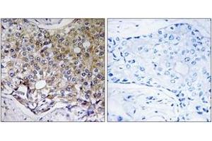 Immunohistochemistry analysis of paraffin-embedded human breast carcinoma tissue, using ATG4A Antibody.