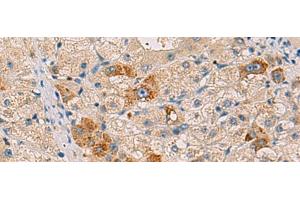 Immunohistochemistry of paraffin-embedded Human liver cancer tissue using RMDN2 Polyclonal Antibody at dilution of 1:50(x200) (FAM82A1 antibody)