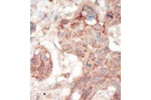 Formalin-fixed and paraffin-embedded human cancer tissue reacted with the primary antibody, which was peroxidase-conjugated to the secondary antibody, followed by AEC staining. (FLT3 antibody  (C-Term))