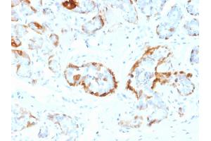 Formalin-fixed, paraffin-embedded human Breast stained with Crystallin Alpha B Mouse Monoclonal Antibody (CPTC-CYRAB-1). (CRYAB antibody)