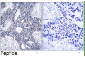 Immunohistochemical analysis of paraffin-embedded human breast carcinoma tissue using ZAP70 polyclonal antibody  .