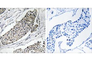 Peptide - +Immunohistochemistry analysis of paraffin-embedded human breast carcinoma tissue using KCNAB3 antibody. (KCNAB3 antibody  (C-Term))