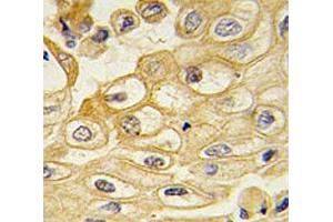 IHC testing of FFPE human lung carcinoma with ROR1 antibody. (ROR1 antibody)