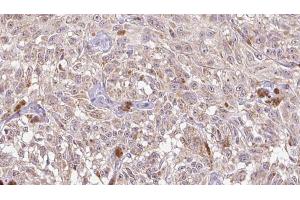 ABIN6268692 at 1/100 staining Human Melanoma tissue by IHC-P. (IL-8 antibody  (Internal Region))