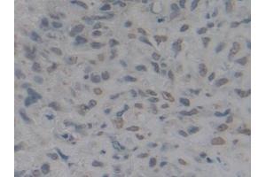 Detection of HMGB1 in Human Lung cancer Tissue using Polyclonal Antibody to High Mobility Group Protein 1 (HMGB1) (HMGB1 antibody  (AA 9-163))