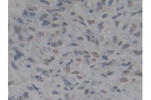 Detection of HMGB1 in Human Lung cancer Tissue using Polyclonal Antibody to High Mobility Group Protein 1 (HMGB1)