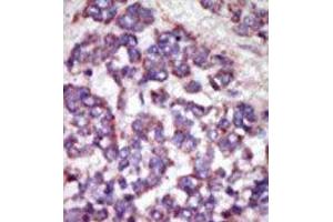 Formalin-fixed and paraffin-embedded human cancer tissue reacted with the primary antibody, which was peroxidase-conjugated to the secondary antibody, followed by AEC staining. (LATS1 antibody  (N-Term))