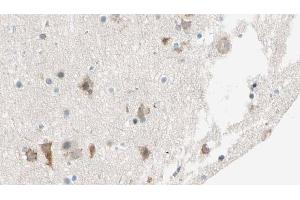 ABIN6274542 at 1/100 staining Human brain cancer tissue by IHC-P. (SHPK antibody  (N-Term))
