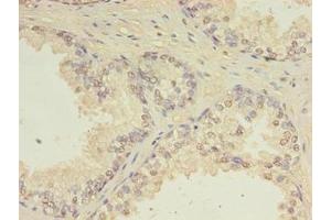 Immunohistochemistry of paraffin-embedded human prostate cancer using ABIN7147411 at dilution of 1:100 (CEP63 antibody  (AA 1-495))