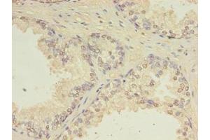 Immunohistochemistry of paraffin-embedded human prostate cancer using ABIN7147411 at dilution of 1:100 (CEP63 antibody  (AA 1-495))