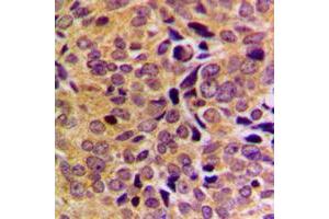 Immunohistochemical analysis of GAS8 staining in human breast cancer formalin fixed paraffin embedded tissue section. (GAS8 antibody  (Center))