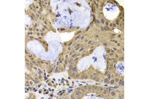 Immunohistochemistry of paraffin-embedded human oophoroma using TERF2IP antibody (ABIN5975683) at dilution of 1/100 (40x lens). (RAP1 antibody)