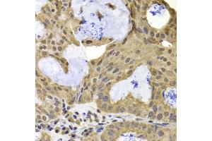Immunohistochemistry of paraffin-embedded human oophoroma using TERF2IP antibody (ABIN5975683) at dilution of 1/100 (40x lens).