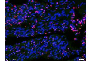 Formalin-fixed and paraffin-embedded human colon carcinoma labeled with Anti-DATF1/IDO1 Polyclonal Antibody, Unconjugatedused at 1:200 dilution for 40 minutes at 37°C. (IDO1 antibody  (AA 1-100))