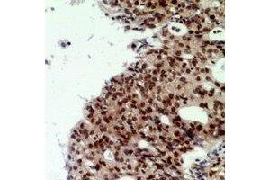 Immunohistochemical analysis of CNOT7 staining in human ovarian cancer formalin fixed paraffin embedded tissue section. (CNOT7 antibody  (N-Term))