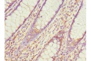 Immunohistochemistry of paraffin-embedded human colon cancer using ABIN7164695 at dilution of 1:100