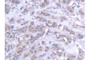 DAB staining on IHC-P; Samples: Human Breast cancer Tissue (ABCB6 antibody  (AA 590-842))